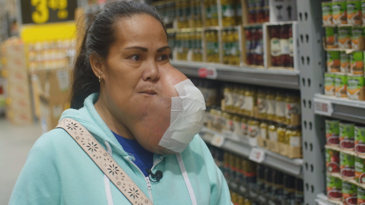 Tongan Mum Of Nine Gets Life Saving Surgery Removing Facial Tumour In Nz — Thecoconettv The 1026